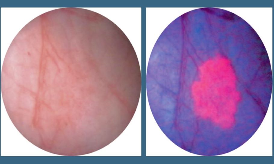 Cystoscopy Light Comparison 